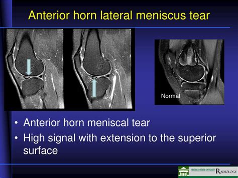 Anterior Horn Lateral Meniscus Tear