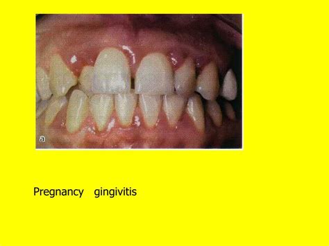 Ppt Pregnancy Gingivitis Powerpoint Presentation Free Download Id