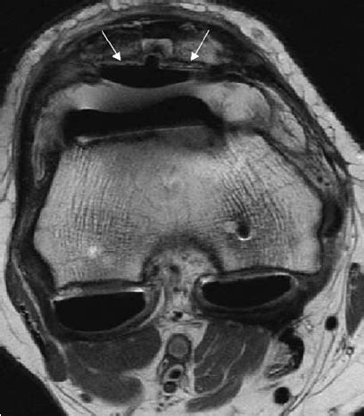 Axial Fast Spin Echo Proton Density Weighted Mr Image Of The Knee