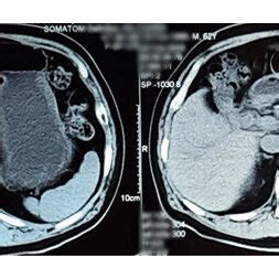 Contrast Enhanced Computed Tomography Cect Abdomen Pelvis Showing