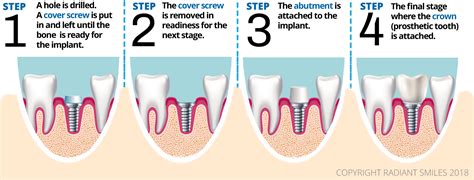 Dental Implants PERTH Cost – Best Affordable Tooth Implant Prices 2023