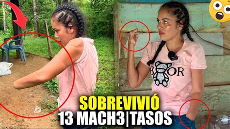 ELLA SOBREVIVIÓ A VARIOS MACHETASOS POR SU EX PAREJA QUEDO SIN MANOS