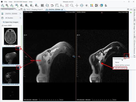 Weasis Dicom Medical Viewer Image Viewing Software