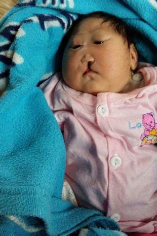 Heart-Wrenching Images Depict Deformed Infant Continuing the Struggle for Life, Defying Initial ...