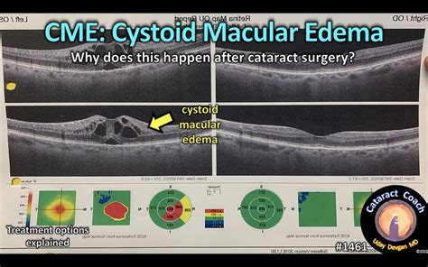 1461 Cystoid Macular Edema Cataract Coach