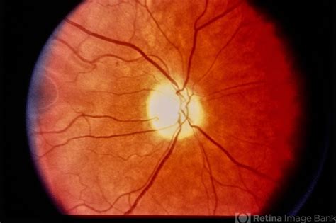 Quinine Toxicity Retina Image Bank