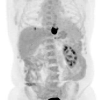 The Maximum Intensity Projection Mip Image From Initial