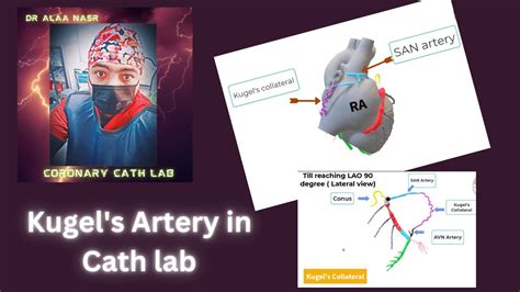 Kugel S Artery Coronary Angiography CTO In 3D English Dr Alaa Nasr