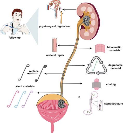 Comprehensive Approach To Ureteral Stents Encrustation Prevention The