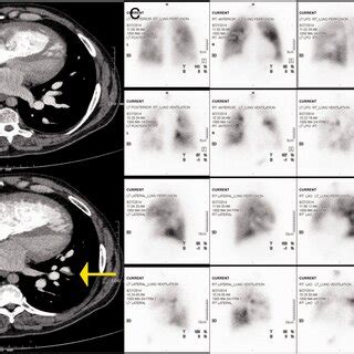 Panel A And B Axial Contrast Enhanced Ct Mage Showing A Large Filling