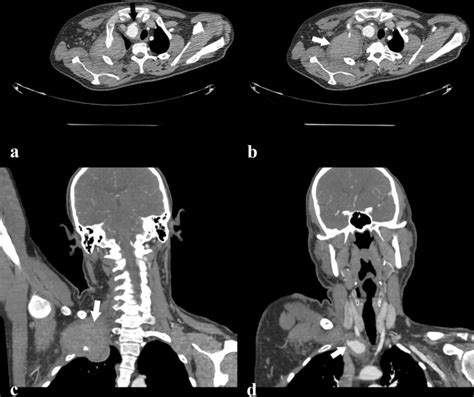 Preoperative Contrast Enhanced Computed Tomography Angiogram Cta A