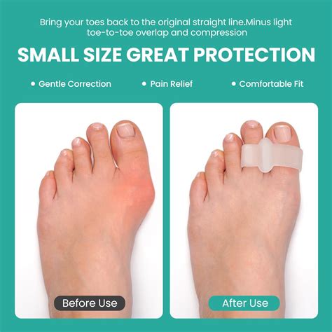 Welnove 12 Pack Gel Bunion Corrector With Aloe Extract Toe Separators