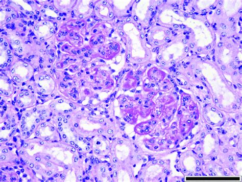 Membranoproliferative Glomerulonephritis The Glomerular Basement