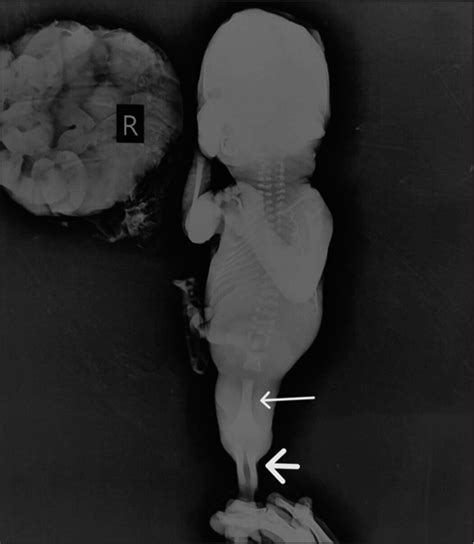 Antenatal Diagnosis Of Sirenomelia The Mermaid Syndrome With Bilateral