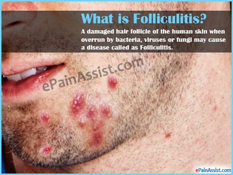 what cause folliculitis - pictures, photos