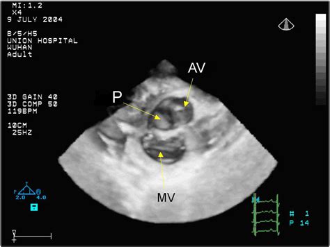 Pseudoaneurysm Of The Mitral Aortic Intervalvular Fibrosa