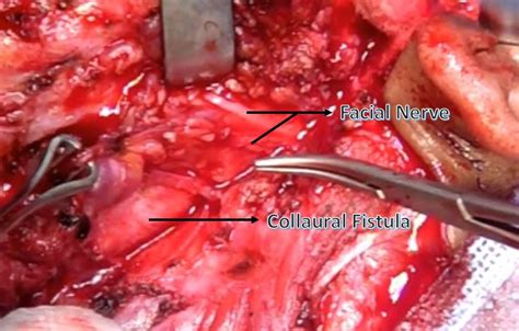 Collaural Fistula With Bony Tract A Surgical Challenge Bmj Case Reports