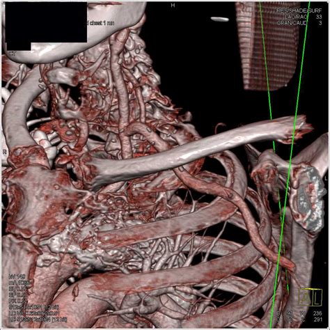 Occlusion Left Subclavian Artery With Bypass From The Left Carotid Artery Vascular Case