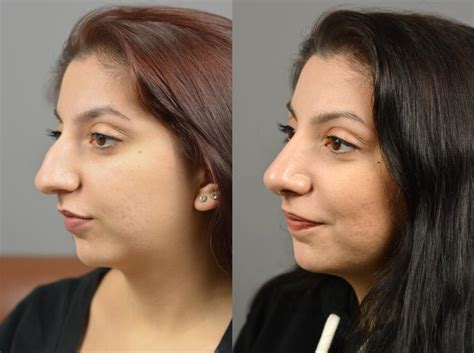 Nose Surgery Before After Patient 18 Dr Marotta