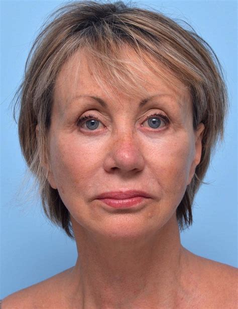 Botox For Nasolabial Folds Cosmetic Surgery Tips