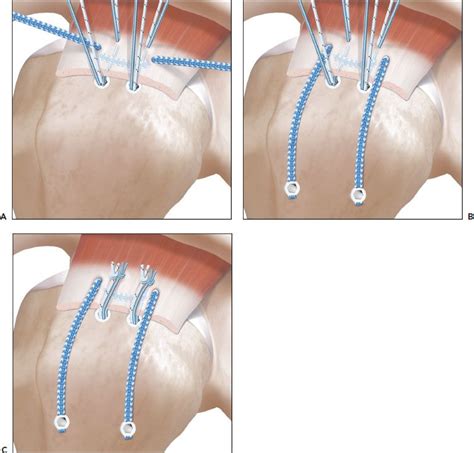 Rotator Cuff Tear Arthroscopic Surgery