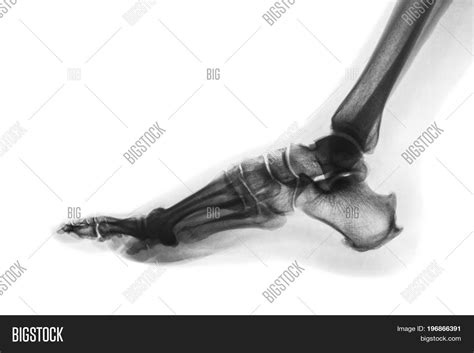 X Ray Normal Human Image Photo Free Trial Bigstock