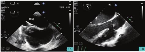 A Midesophageal Ascending Aortic Short Axis View Showing The Ascending