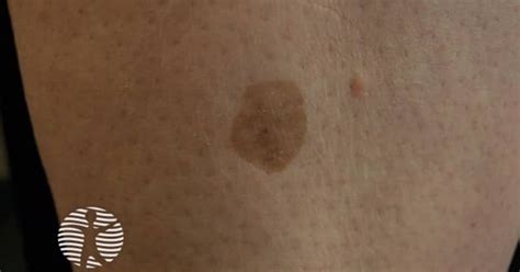 Solar Lentigo Image