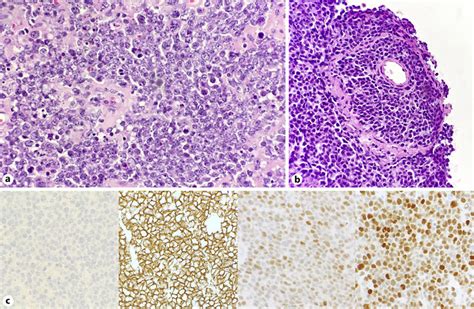 Histological Assessment Of The Permanent Specimen A Dense Download Scientific Diagram