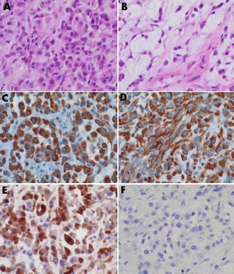 Histological And Immunohistochemical Findings Biphasic Malignant