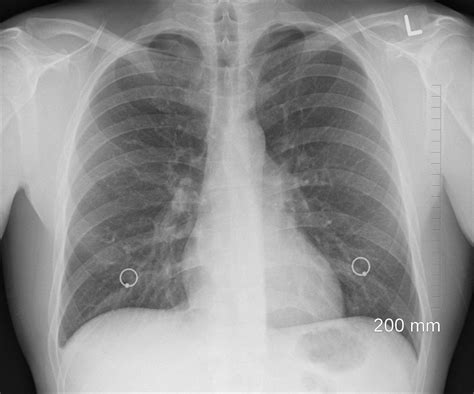 Asbestos in lungs | Symptoms and Treatments