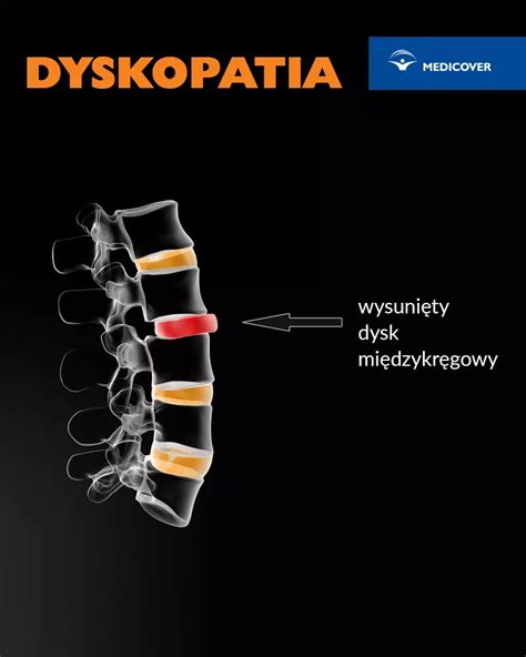 Dyskopatia Szyjna Dyskopatia Szyjna Objawy