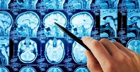 La Neurologia Cuenta Con Un Nuevo Aliado Una Nueva Resonancia