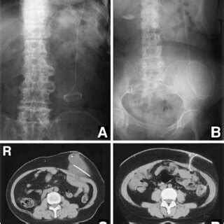 A Case Abdominal Radiograph Showing The Peritoneal Catheter Coiled