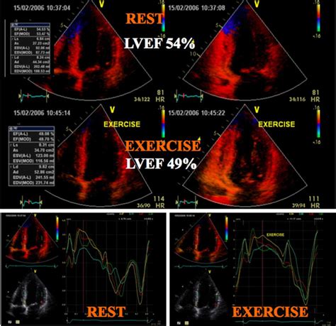 Stress Echocardiography In Regurgitant Valve Disease Circulation