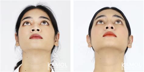 Rhinoplasty Nose Job Kamol Cosmetic Hospital