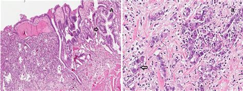 Figure From Synchronous Gallbladder Adenocarcinoma And Gastric