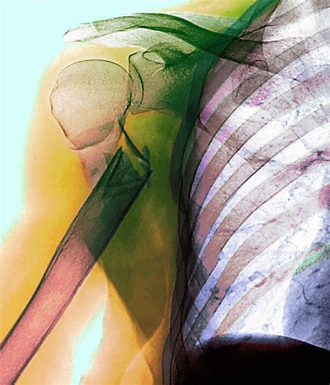 fractured arm  photograph  science photo library pixels
