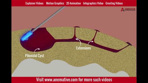 Anemative Pilonidal Sinus Explainer Video Laser Treatment