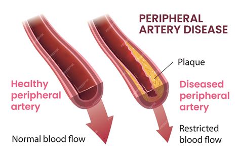 Premium Vector Illustration Of Peripheral Artery Disease Infographic