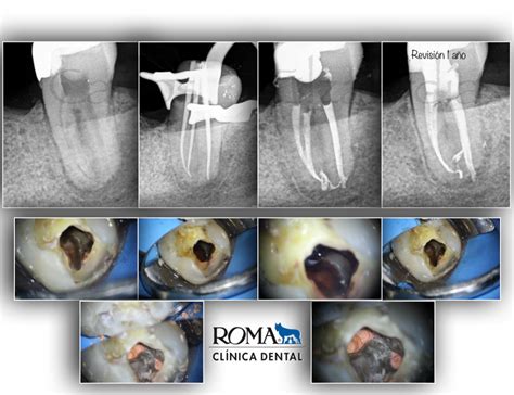 Raio X De Dente Necrosado BRAINCP