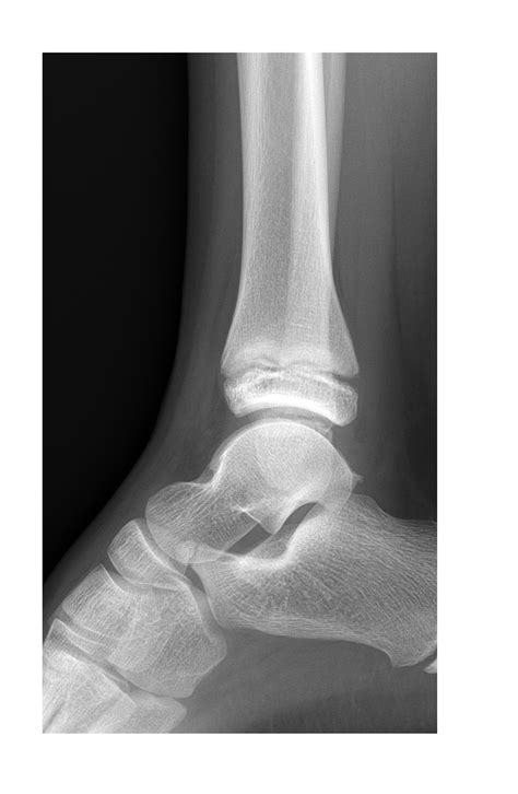 Ankle X Ray 3 Emergucate