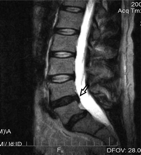 Sagittal Mri Demonstrates L4 L5 Disc Extrusion Download Scientific Diagram