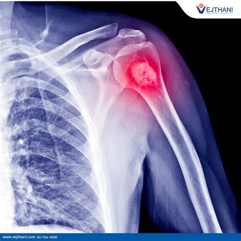 Discover More About Bone Cancer & Its Symptoms | Vejthani