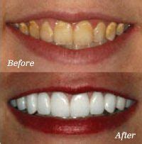 Teeth Bleaching Before And After