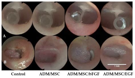 Tympanic Membrane Perforation