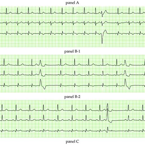 Examples Of Vcgs Of Subjects With A Supraventricular Ectopic Beat With Download Scientific