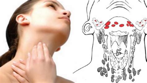 Stage 3 Lymph Node Cancer Survival Rate - CancerOz