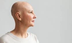 Understanding The Different Types Of Alopecia Mcan Health Blog