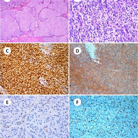 The Microscopic Features And Immunohistochemical Stains Of The Lesion